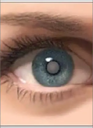 Cataract effected eye