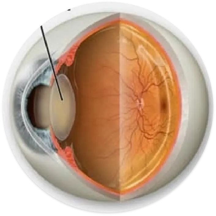 Cataract eye demo image