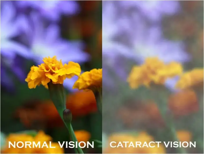 Cataract vision comparison
