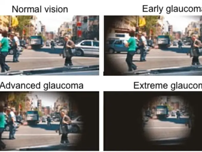 Symptoms of glaucoma