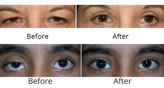 treatment before and after eye images. surgery done by Abate's Oculoplastic specialists