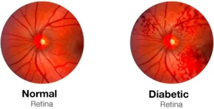 Retinopathy clinic in Kerala