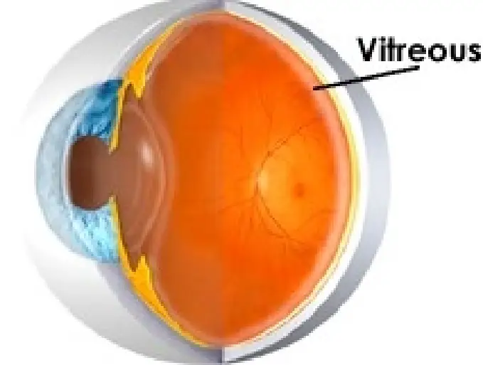 Cataract Thumbnail